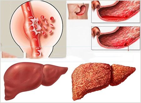 Xơ gan F4 là gì? Nguyên nhân và triệu chứng của bệnh