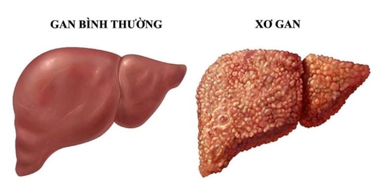 Xơ gan giai đoạn cuối sống được bao lâu?