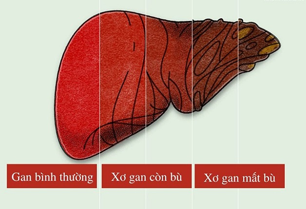 Xơ gan giai đoạn mất bù còn sống được bao lâu?