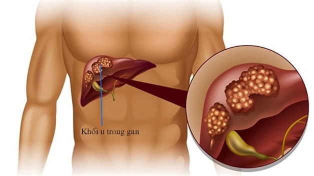 Xơ gan giai đoạn mất bù còn sống được bao lâu?