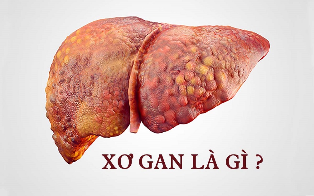 Xơ gan là gì? Phân loại xơ gan theo từng giai đoạn