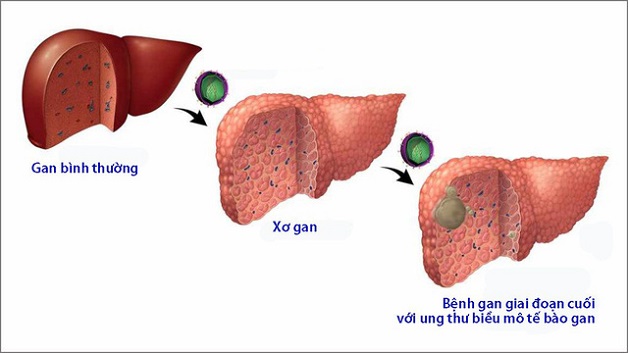 Xơ gan là gì và có nguy hiểm không?