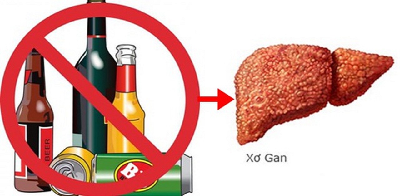 Xơ gan rượu nguy hiểm như thế nào và cách phòng ngừa