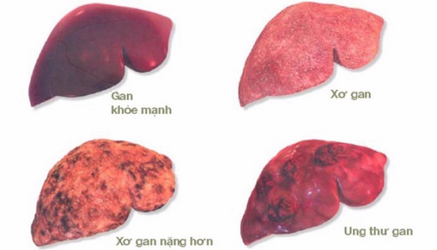 Xơ gan rượu nguy hiểm như thế nào và cách phòng ngừa