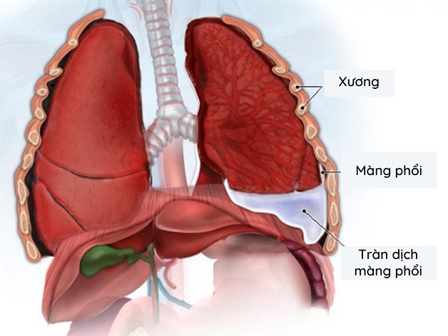 Xơ gan tràn dịch màng phổi: Biến chứng nguy hiểm