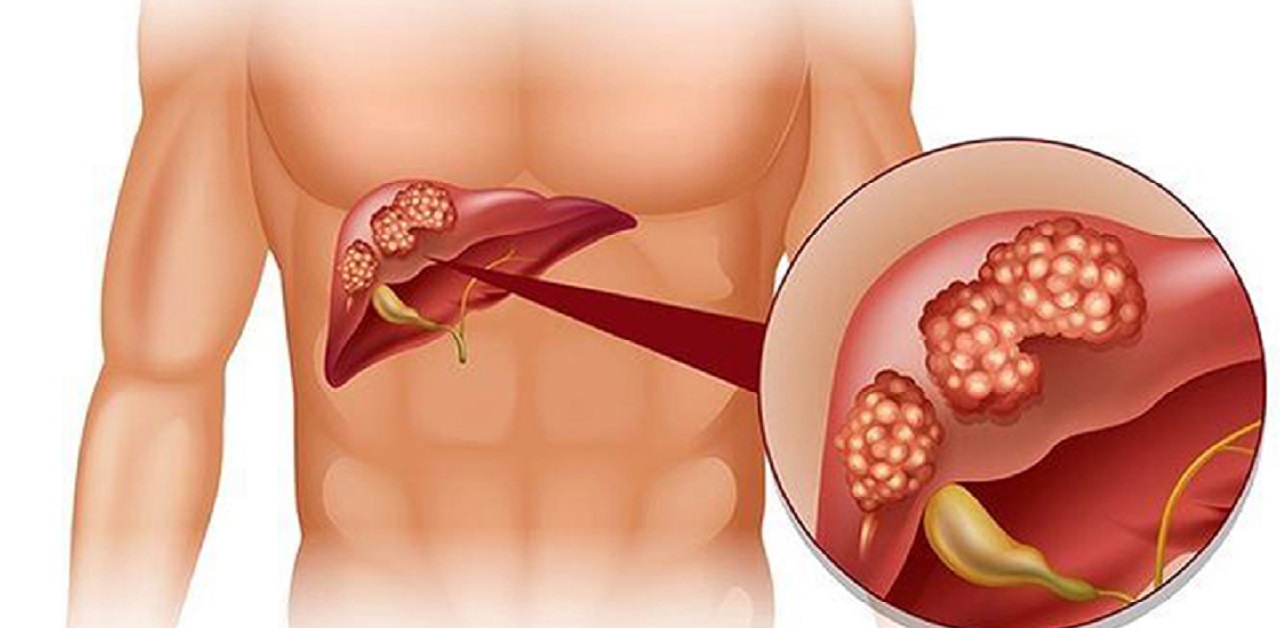 Xơ gan triệu chứng: Nguyên nhân, các giai đoạn và biến chứng