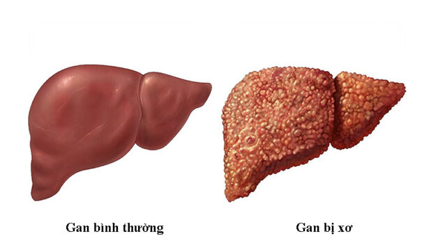 Xơ gan uống thuốc gì và cách phòng ngừa