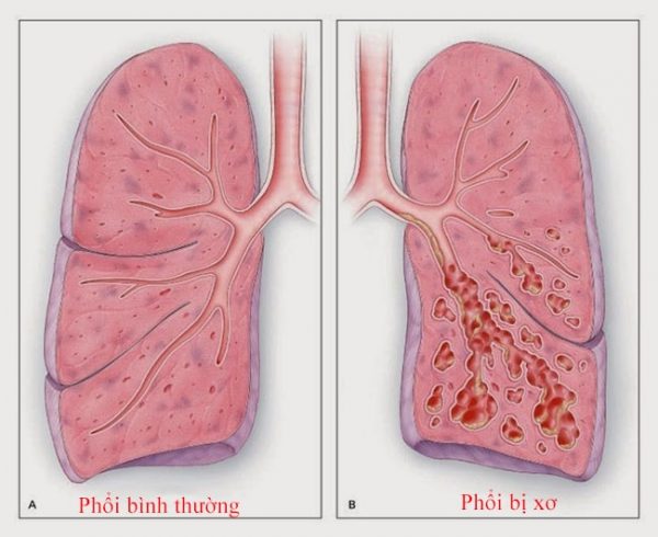 Xơ phổi có nguy hiểm không?