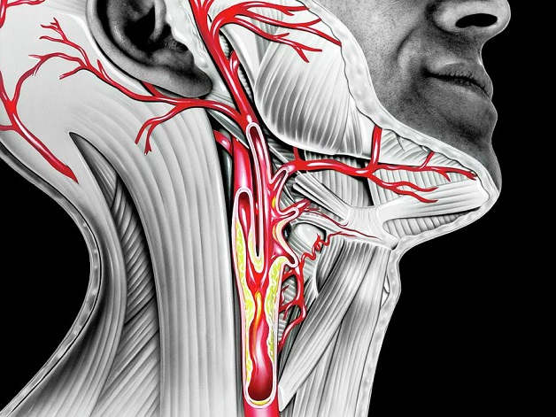 Xơ vữa động mạch cảnh là gì? Nguyên nhân, triệu chứng