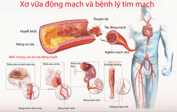 Xơ vữa động mạch là gì?