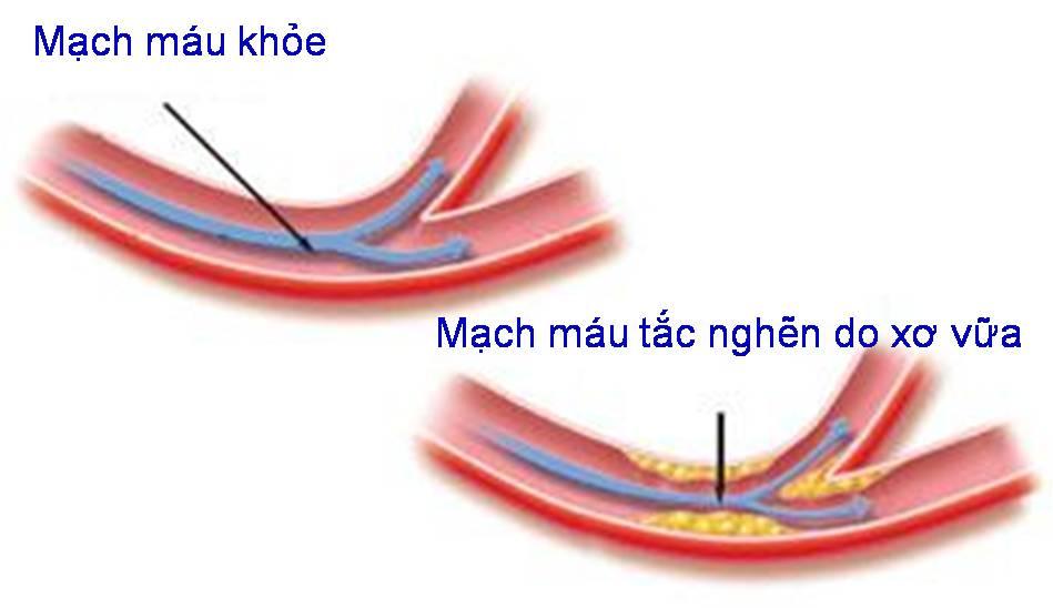 Xơ vữa động mạch: Nguyên nhân khởi phát bệnh