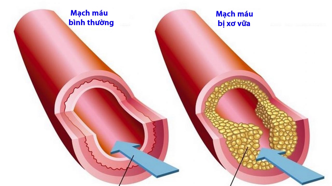 Xơ vữa động mạch: Triệu chứng, hậu quả