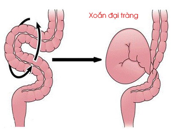 Xoắn ruột là gì?| Biểu hiện và điều trị