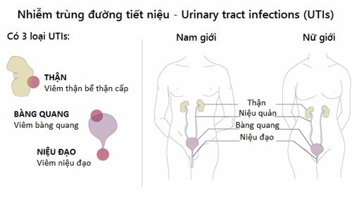 Xử lý khi bị nhiễm trùng tiết niệu ở phụ nữ