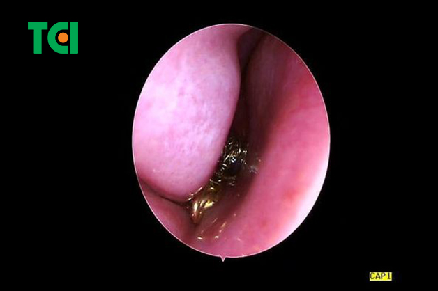 Xử lý nhanh lấy dị vật trong lỗ mũi trẻ