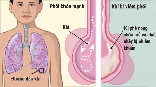 Xử trí hiệu quả để ngăn ngừa các biến chứng viêm phổi