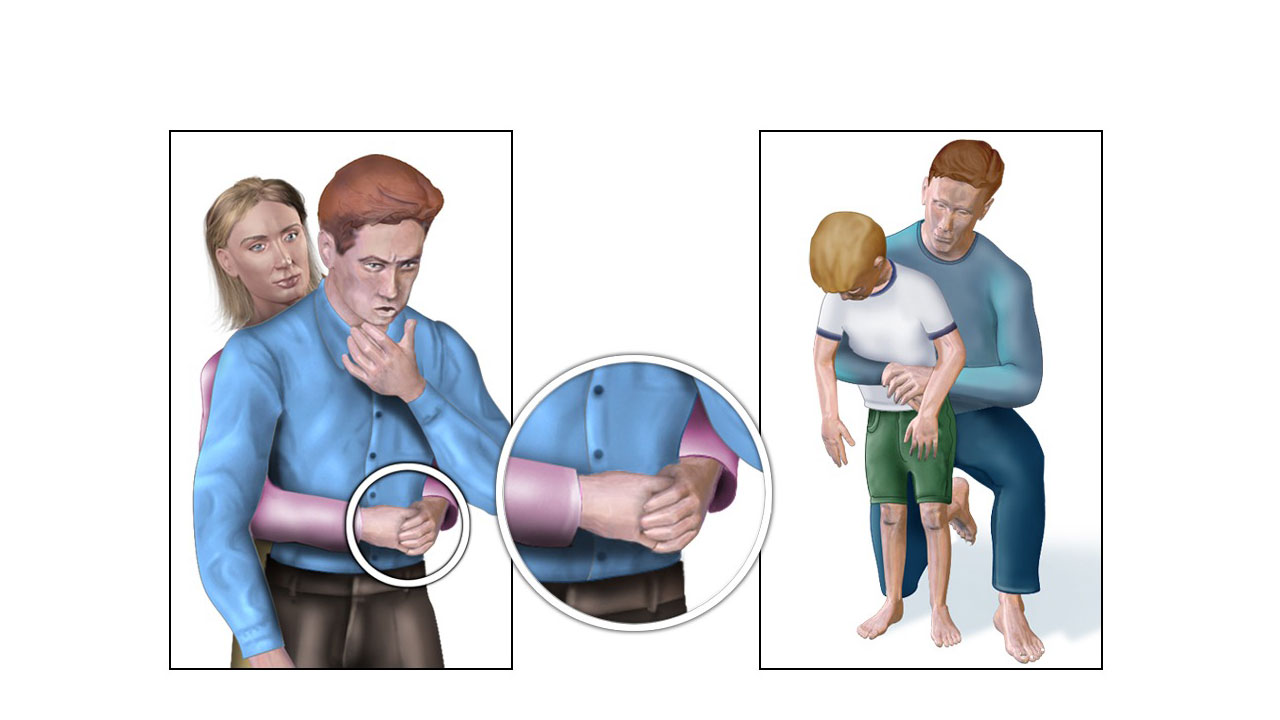 Xử trí hóc dị vật đường thở đúng cách theo từng nhóm đối tượng