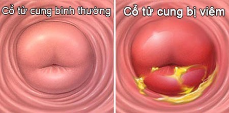 Xử trí viêm cổ tử cung mạn tính