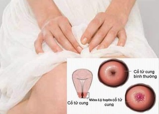 Xử trí viêm cổ tử cung mạn tính