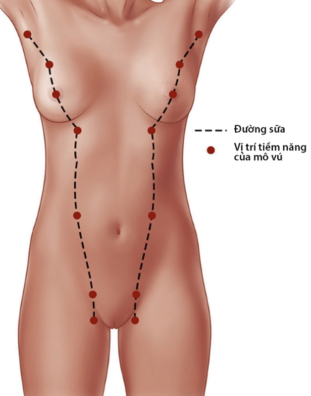 Xuất hiện tuyến vú phụ ở nách có đáng lo ngại?