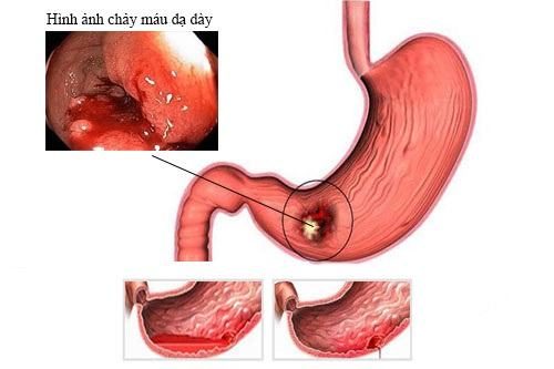 Xuất huyết dạ dày có đau không?