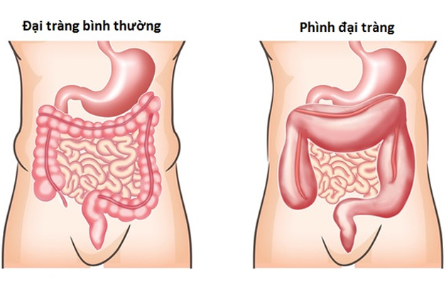 Xuất huyết đại tràng: Cảnh báo các biến chứng nguy hiểm