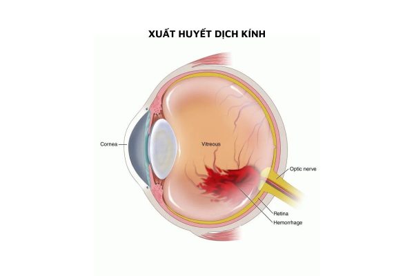 Xuất huyết dịch kính là gì, có nguy hiểm không?