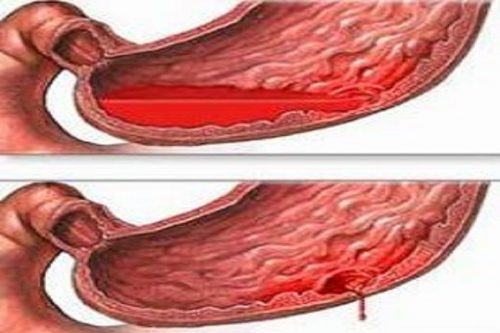 Xuất huyết tiêu hóa cần xét nghiệm gì?