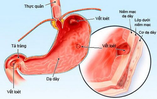 Xuất huyết tiêu hóa dùng thuốc gì?