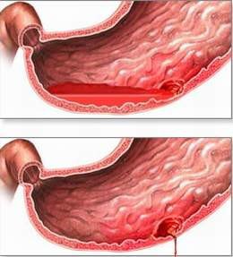 Xuất huyết tiêu hóa ở trẻ em: nguyên nhân, biểu hiện