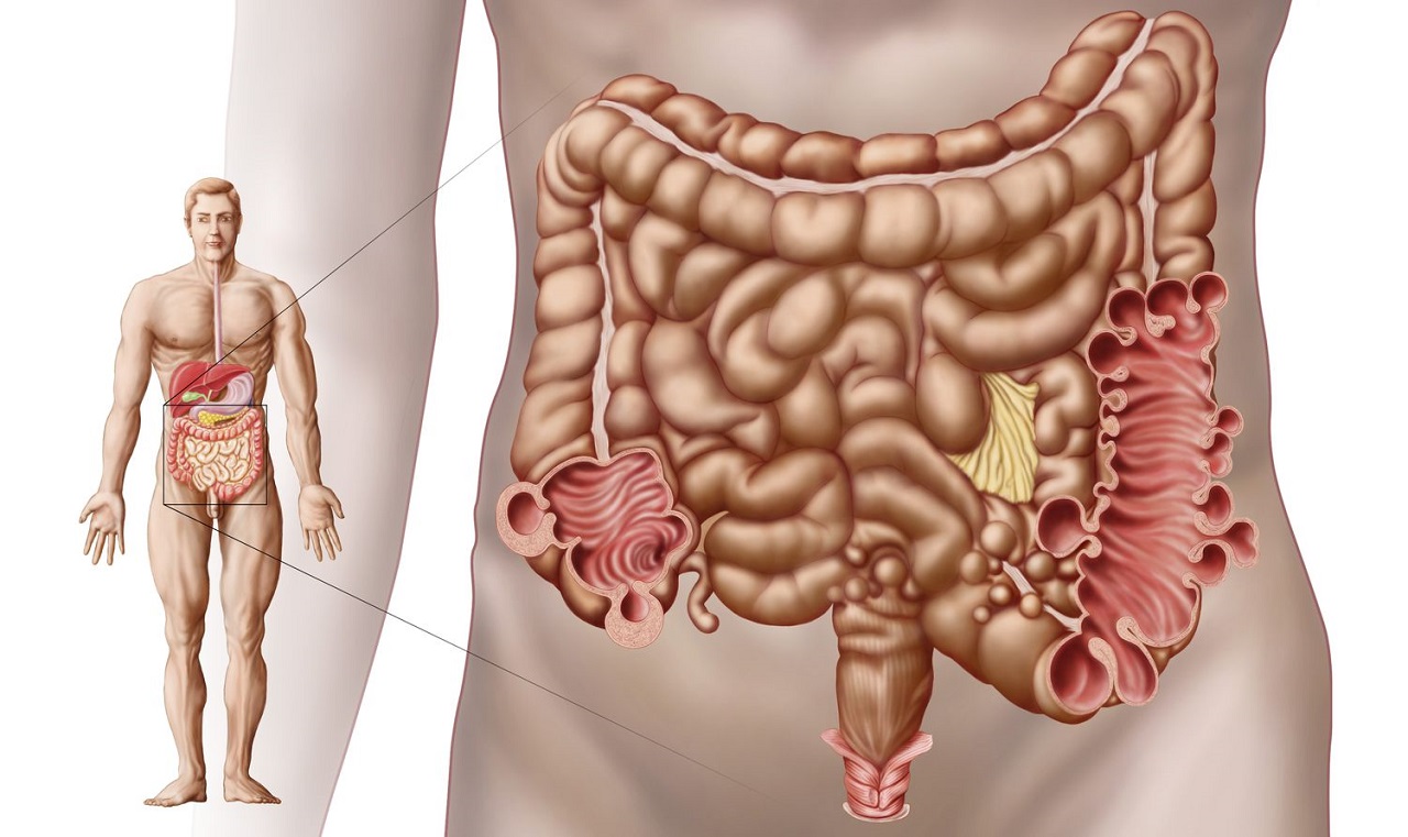 Xuất huyết túi thừa đại tràng: Triệu chứng và điều trị