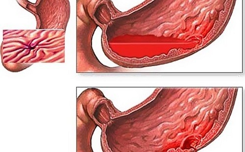 Xung huyết dạ dày có nguy hiểm không?