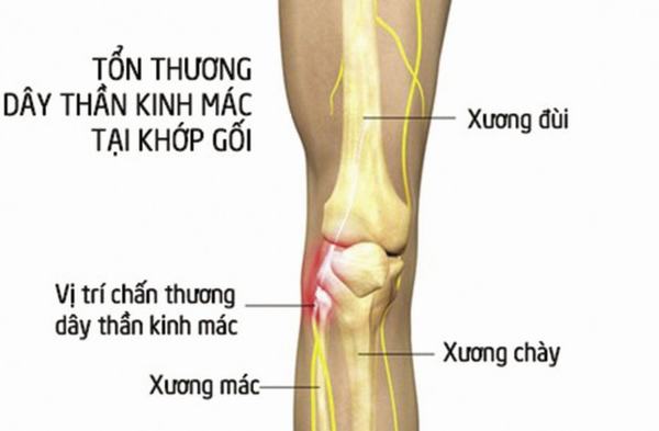 Xương mác chân nằm ở đâu? Vì sao xương mác dễ bị gãy?