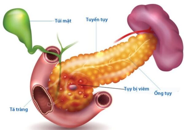 Yêu cầu trong điều trị viêm tụy cấp thể hoại tử 