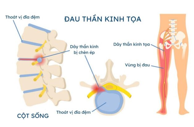 Yoga chữa đau dây thần kinh tọa và một số lưu ý